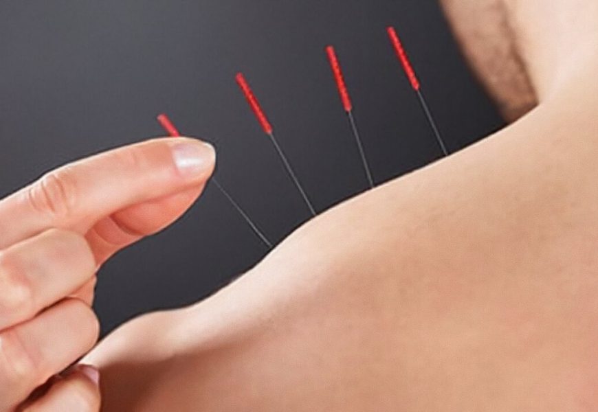 Acupuncture aids outcomes after heart valve surgery