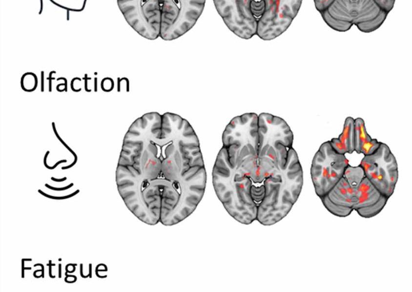 Novel MRI reveals brain changes in long COVID patients