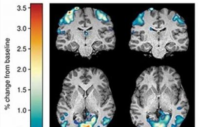 Researchers publish a new model to predict improvement in brain health